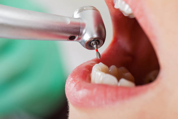 Best Emergency Tooth Extraction in Macarthur, WV